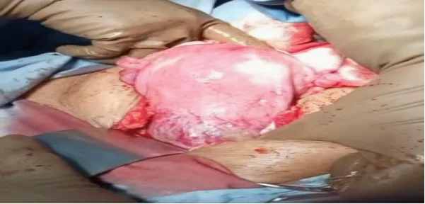 cesarean-scar-ectopic-pregnancy