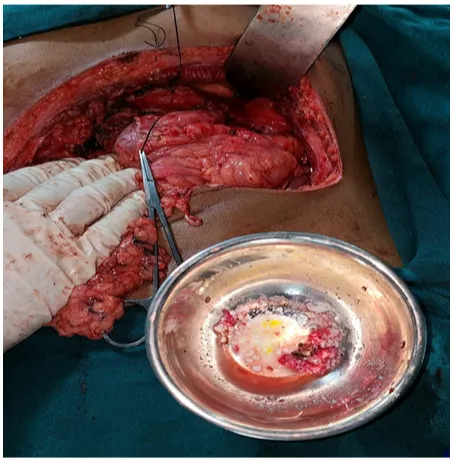 chronic-calcific-pancreatitis-01