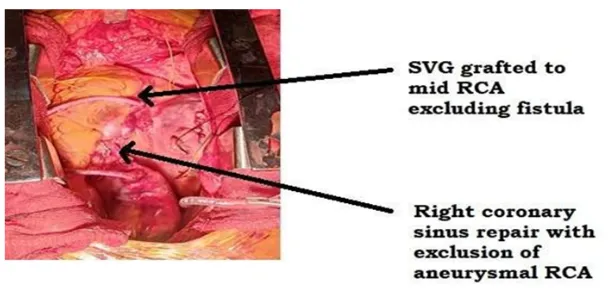 coronary-artery-fistula-5