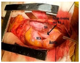 coronary-artery-fistula-3