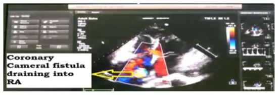 coronary-artery-fistula-1