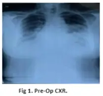 diaphragmatic-hernia-01