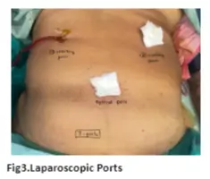 diaphragmatic-hernia-03