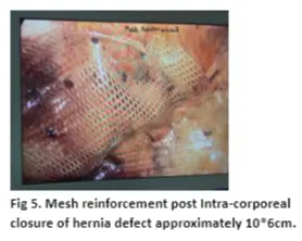 diaphragmatic-hernia-05