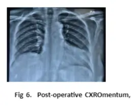 diaphragmatic-hernia-06