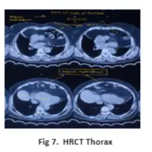 diaphragmatic-hernia-07