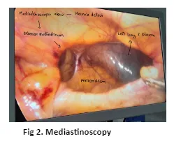 diaphragmatic-hernia-02