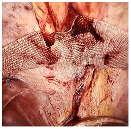 diaphragmatic-hernia-4