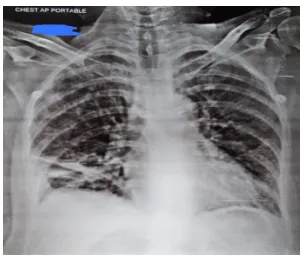 diaphragmatic-hernia-6