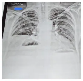 diaphragmatic-hernia-5