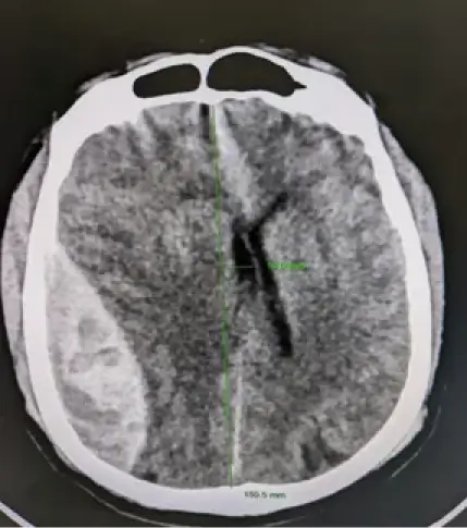 extra-dural-hematoma-1