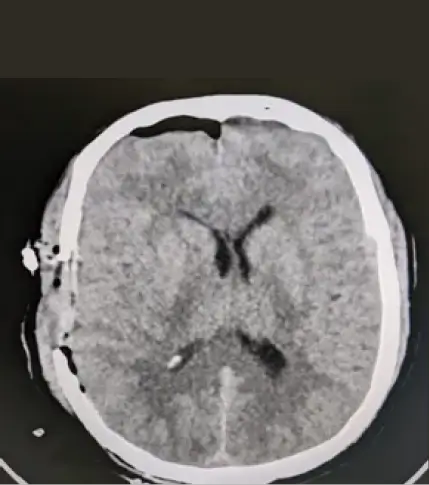 extra-dural-hematoma-2