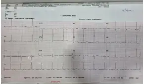 guillain-barre-syndrome-masquerading-as-angina-pectoris