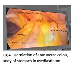 diaphragmatic-hernia-04