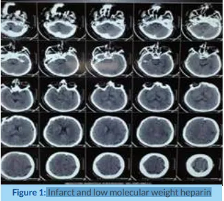 infarct-and-low-molecular-weight-heparin-1