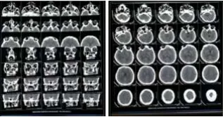 infarct-and-low-molecular-weight-heparin