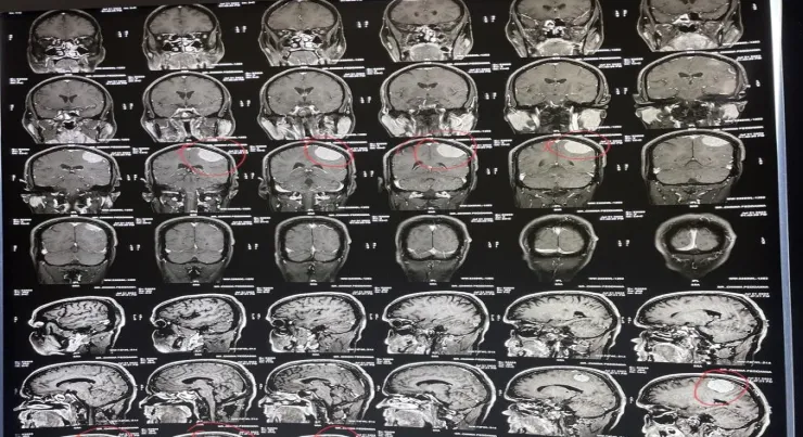 left-parietal-craniotomy-and-tumor-excision-1