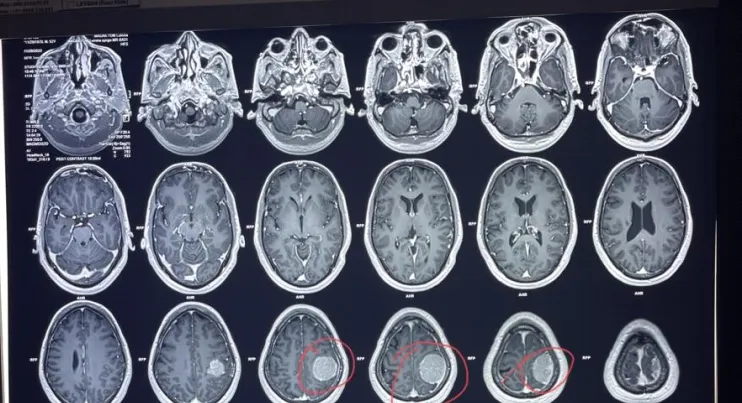 left-parietal-craniotomy-and-tumor-excision-2