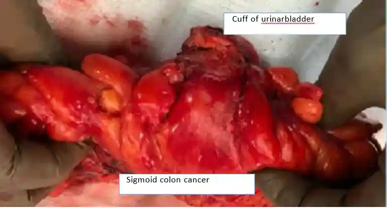 locally-advanced-sigmoid-colon-cancer