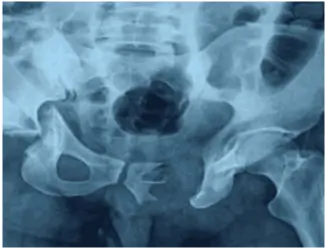 pelvic-acetabular-fracture 1