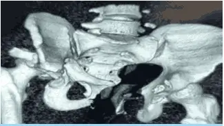 pelvic-acetabular-fracture 2