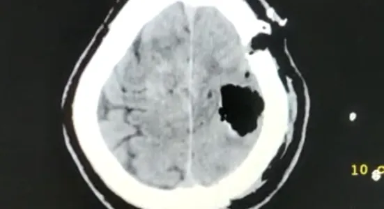 left-parietal-craniotomy-and-tumor-excision-8