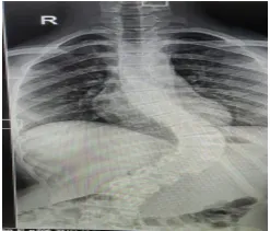 scoliosis-deformity-correction