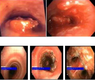 central-airway-obstruction-3