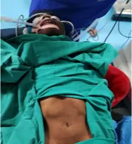 rare-occurrence-of-hydatid-cyst-over-abdominal-wall-1