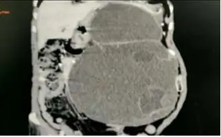 retroperitoneal-mass-1