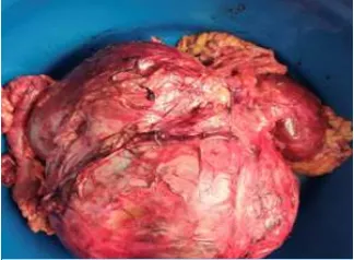 retroperitoneal-mass-2