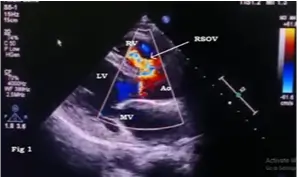 ruptured-sinus-of-valsalva-aneurysm-1