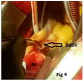 ruptured-sinus-of-valsalva-aneurysm-4