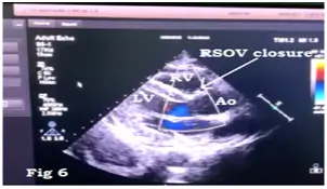 ruptured-sinus-of-valsalva-aneurysm-6