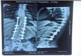 scoliosis-deformity-correction