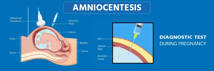 Amniocentesis Cost