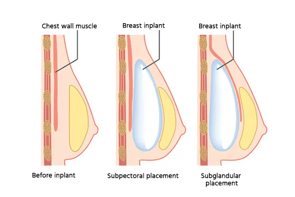 breast-augmentation-surgery