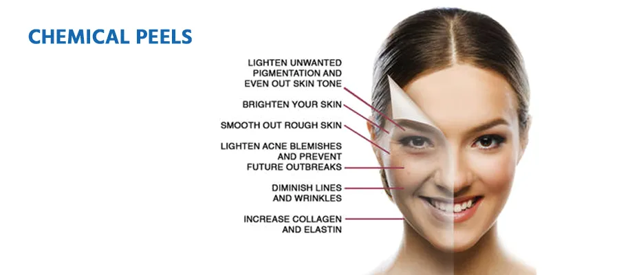 chemical-peel