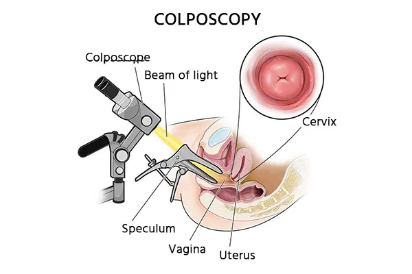 colposcopy-cost