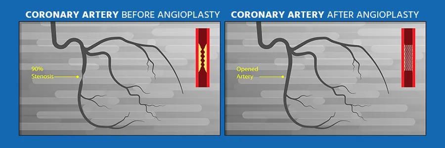 coronary-angiography-cost