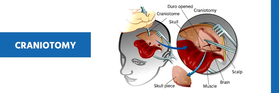 craniotomy-cost