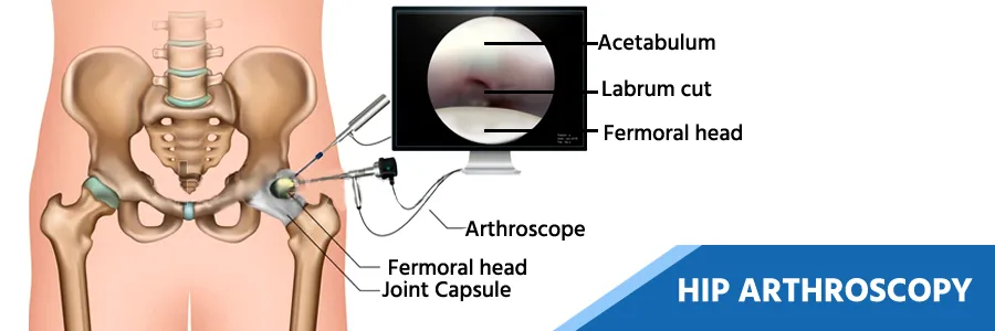 Hip Arthroscopy Surgery