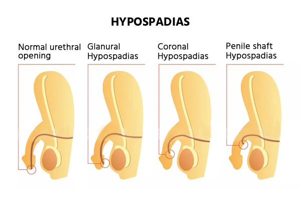 hypospadias repair procedure