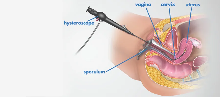 Hysteroscopy