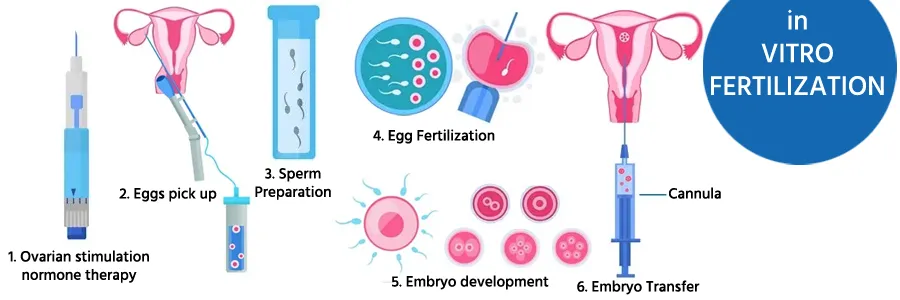 In Vitro Fertilisation