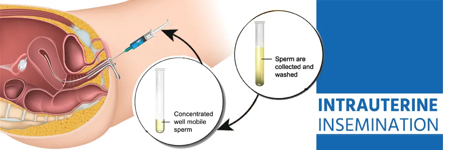 Intrauterine Insemination