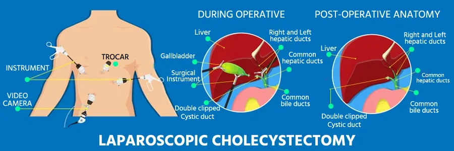 Laparoscopic cholecystectomy