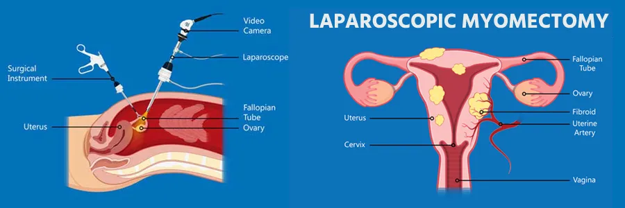 Laparoscopic Myomectomy