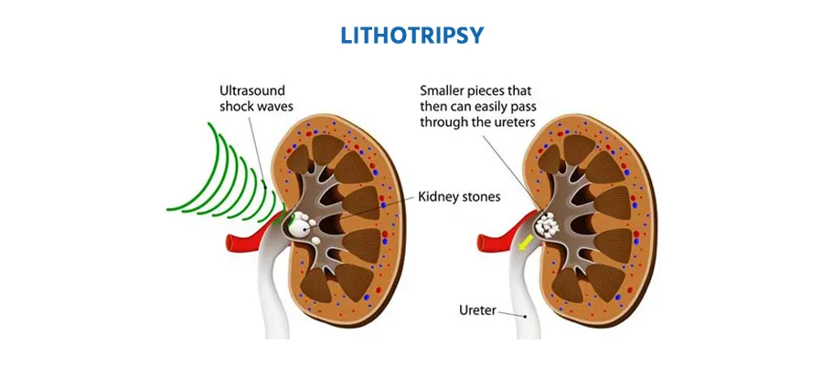 Lithotripsy