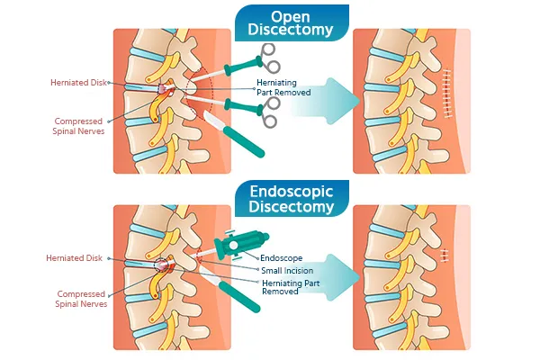 Microdiscectomy